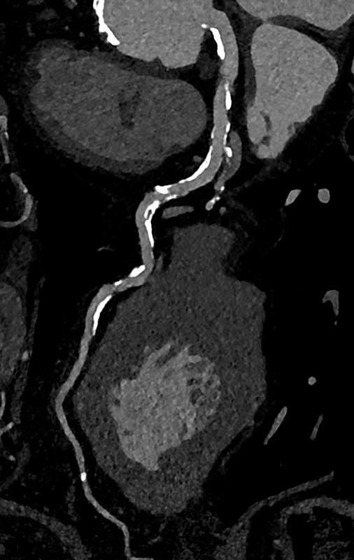 Photon-Counting-CT-Aufnahme, die zeigt, dass die Gefäße nicht verstopft sind.