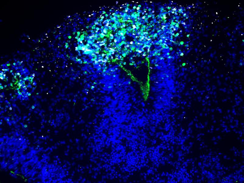 Das Bild zeigt, wie das Herpes-Virus (weiß) sich im Organoid ausbreitet und die Auskleidung eines Ventrikels, also das Neuroepithel, zerstört. Die Zellkerne sind blau zu sehen, das Neuroepithel ist grün angefärbt.