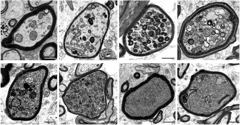The image series shows cross-sectional electron micrographs of individual nerve fibers in MS brain biopsies. Axons sheathed with myelin (black rings) can be seen, showing increasingly severe damage from 1 to 8.