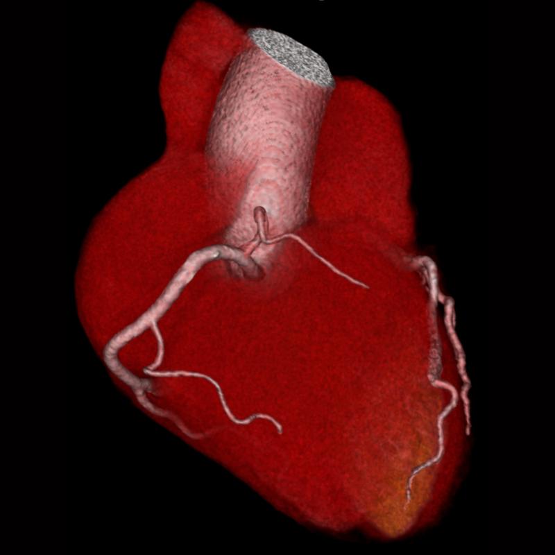 3-D CT (three-dimensional computed tomography) image of the heart: coronary CT angiogram without coronary stenosis.