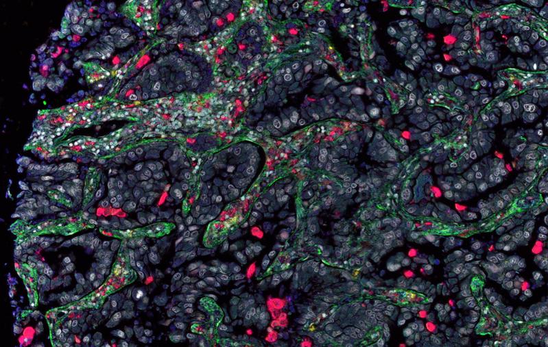 Der Gewebeschnitt eines Lungentumors zeigt verschiedene Zellen des Tumormikromilieus: Makrophagen (rot), Kollagen produzierende Makrophagen oder Fibrozyten (gelb), Fibroblasten (grün).