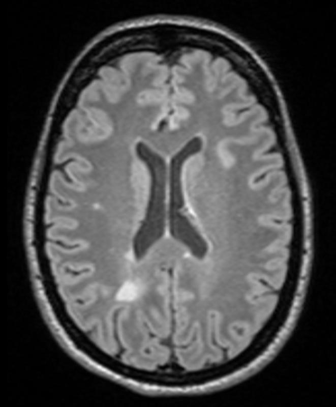 MRT-Bild des Gehirns einer Patientin mit Multipler Sklerose. Die Nervenschädigungen sind als besonders helle Bereiche sichtbar