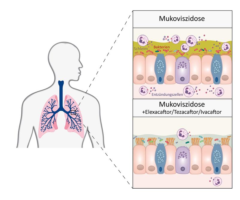 Die Dreifachtherapie mit den Wirkstoffen Elexacaftor, Tezacaftor und Ivacaftor sorgt dafür, dass der Atemwegsschleim bei Mukoviszidose (grün in Abb. oben) weniger zäh ist.