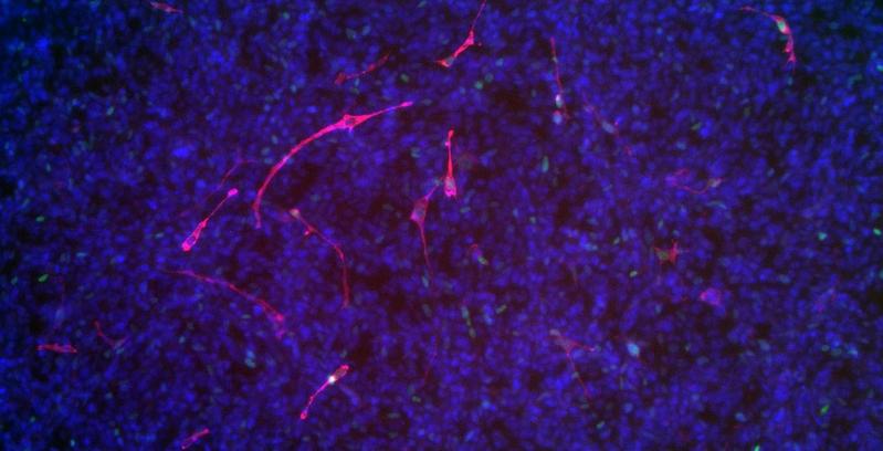 Induktion der myogenen Differenzierung und Reduktion der Zellteilung in Rhabdomyosarkom-Zellen nach Verringerung der Menge von TRPS1 mittels siRNA, in Rot: myosin heavy chain (Marker für differenzierende Muskelzellen), in Grün: Ki67 (Marker für sich ...