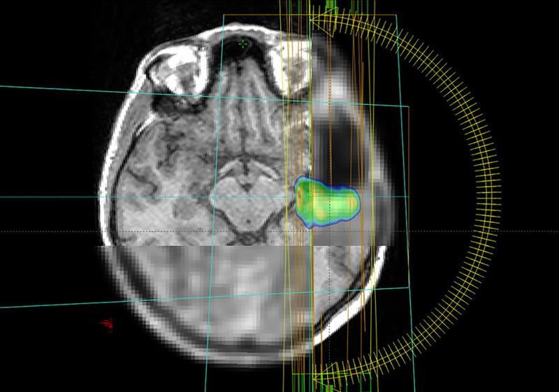 Wie sich die Strahlentherapie aggressiver Hirntumoren durch eine kombinierte Bildgebung weiter verbessern lässt, untersucht das europäische Forschungsteam unter Freiburger Leitung. 