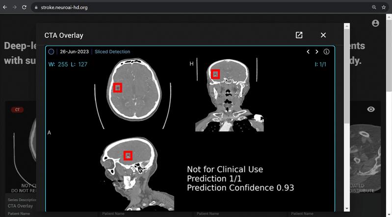Neue KI-Anwendung im Einsatz: Das Analyseprogramm prüft anhand von CT-Bildern, ob ein Gefäßverschluss vorliegt und wie sicher es sich in seiner Diagnose ist. 