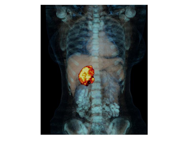 Adrenocortical carcinoma is a malignant degeneration of one of the hormone glands, which sit in pairs as small caps on the kidney. 