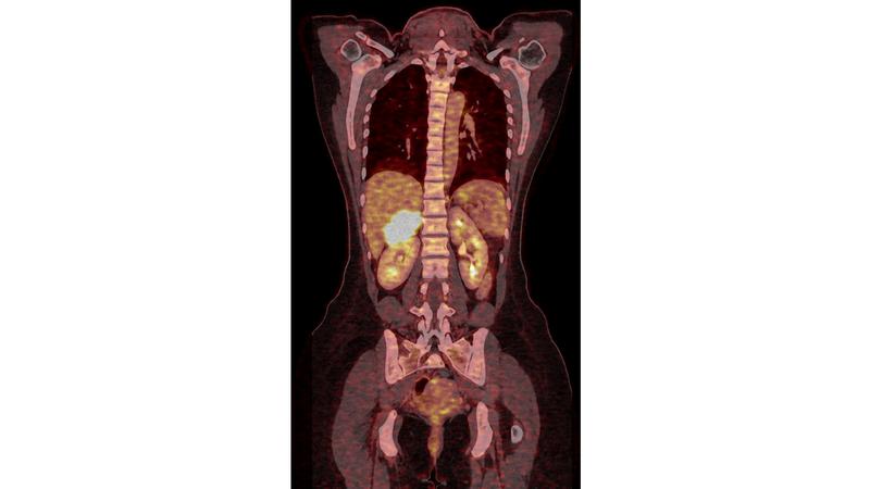 With 80 to 120 new cases in Germany, the adrenocortical carcinoma is very rare. Therefore, there are only a few clinics that specialise in its treatment. The UKW is currently the world's largest centre for diagnosis, therapy and research. 