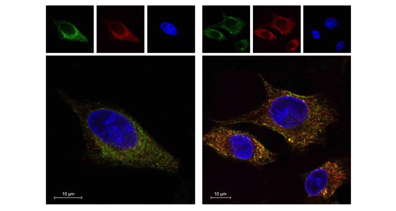 Liegt in einer Tumorzelle mutiertes p53 vor, so reichert sich das Protein ENTPD5 (grün gefärbt) in Membranen (rot) innerhalb der Zelle an. Zusammen wirken sie so auf Integrine ein, dass sich die Beweglichkeit der Tumorzelle erhöht.