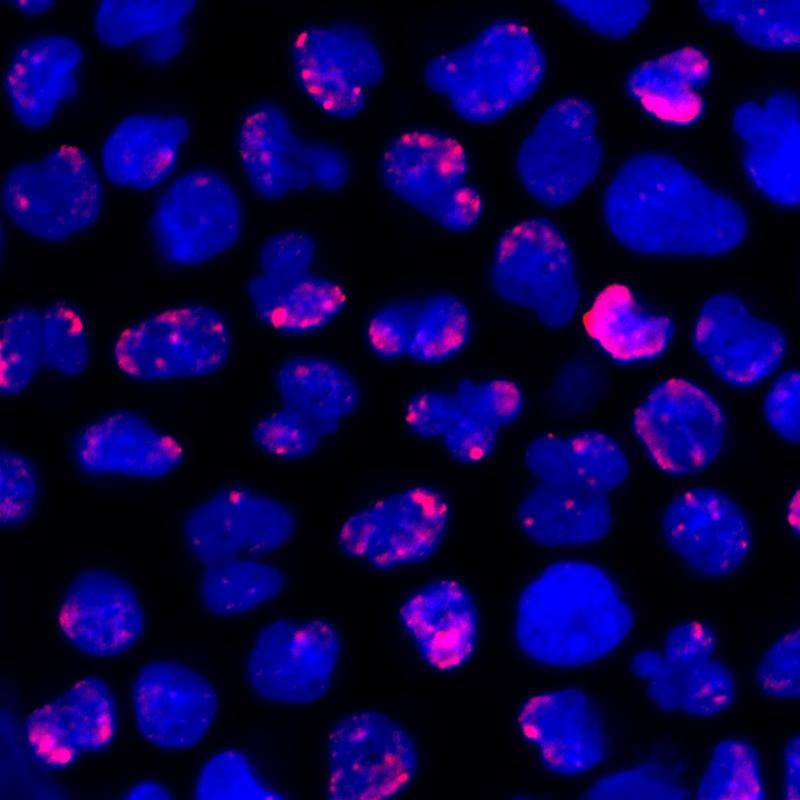 R-Loops (pinke Färbung) häufen sich an AML-Zellen an. Werden sie nicht abgebaut, sterben die Krebszellen vermehrt ab 