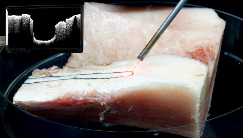 Bone removal with laser and visual control via OCT: LZH researchers aim to facilitate spinal canal stenosis surgeries using laser and visual control via OCT. 