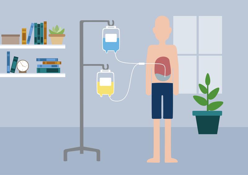 Bei der Peritonealdialyse erfolgt die Blutreinigung innerhalb des Körpers über das Bauchfell, das die Bauchhöhle auskleidet und als Filtermembran dient. Dialysepflichtige Nierenkranke können diese Methode selbständig zu Hause durchführen. 