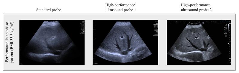 Edited image from the publication: scan of the liver of an obese patient. The image quality of the standard ultrasound probe (left) is significantly poorer than that of the high-performance probes (centre and left).