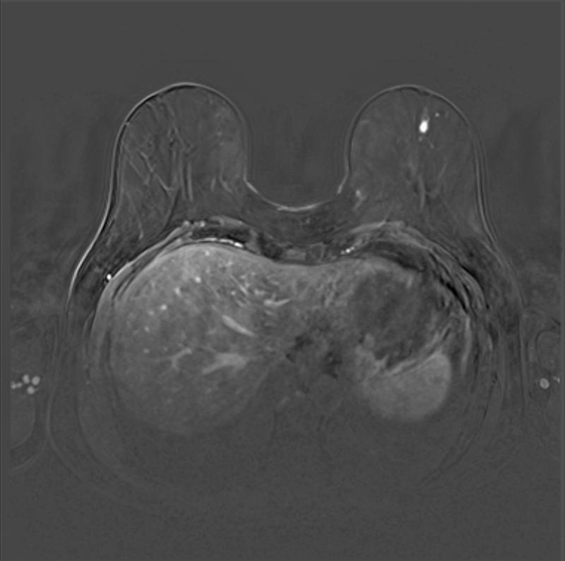 Frühzeitige Detektion eines kleinen (8 mm) Mammakarzinoms der linken Brust bei einer 62-jährigen Patientin mit bekannter Genmutation im MRT