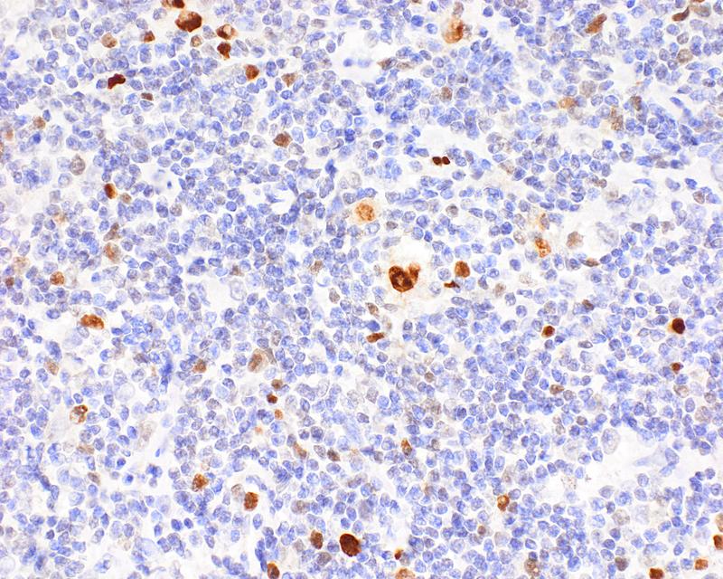 Hodgkin-Tumorzellen (hier IRF4-Färbung in braun) sind sehr groß und tragen die Erkennungszeichen vieler anderer Immunzellen auf ihrer Oberfläche.
