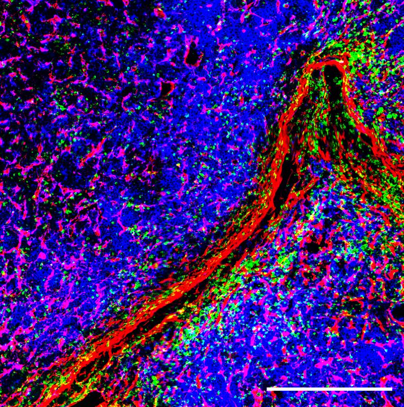 Immunfluoreszenz Bild von einer extramedullären Läsion des Multiplen Myelom, also eines Tumorherdes außerhalb des Knochenmarks. Die bösartigen Plasmazellen sind blau eingefärbt, die T-Zellen grün und stromalen Zellen wie Fibroblasten und Endothelzellen rot