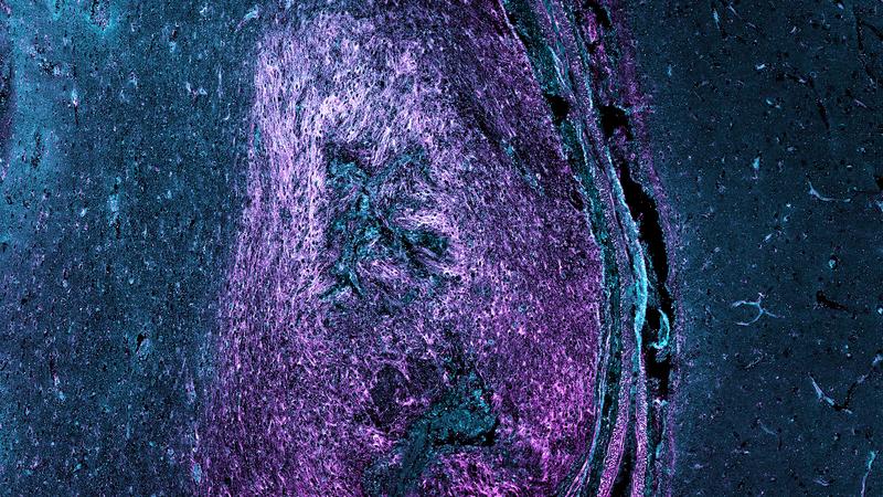 The image shows scar tissue in the human brain after traumatic injury. Deposits of SLRP proteins in the scar are shown in magenta and cyan.