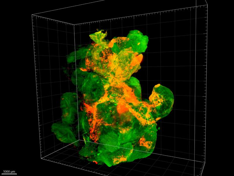 Ein Tumor unter dem Fluoreszenzmikroskop: Das Gewebe dieses Bauchspeicheldrüsentumors in einer Maus leuchtet grün, die Nanopartikel orange. 