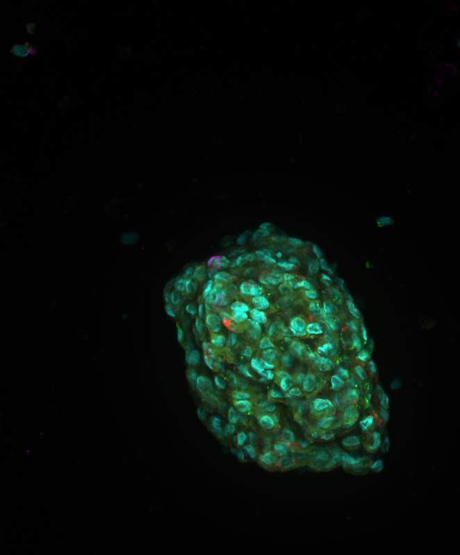 Organoidmodell eines Tumors.