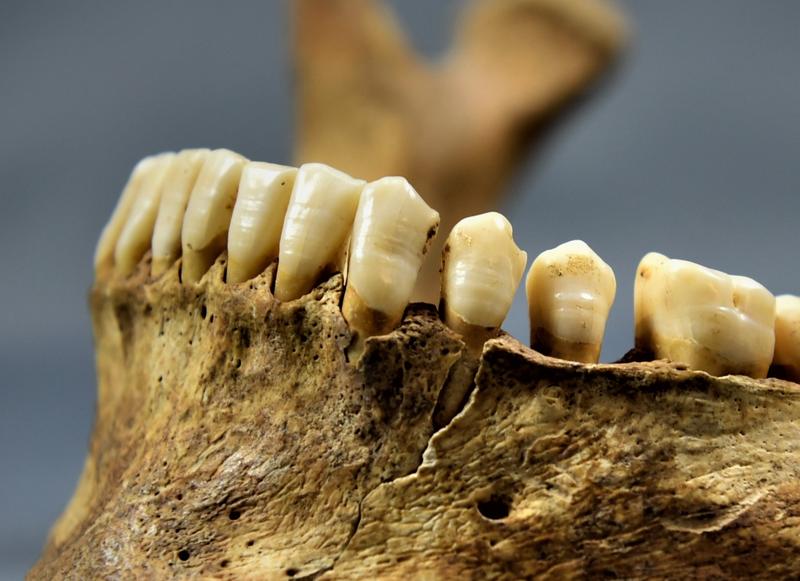 Visible malformations in tooth enamel that occur during dental development and are considered identifiable physiological stress markers