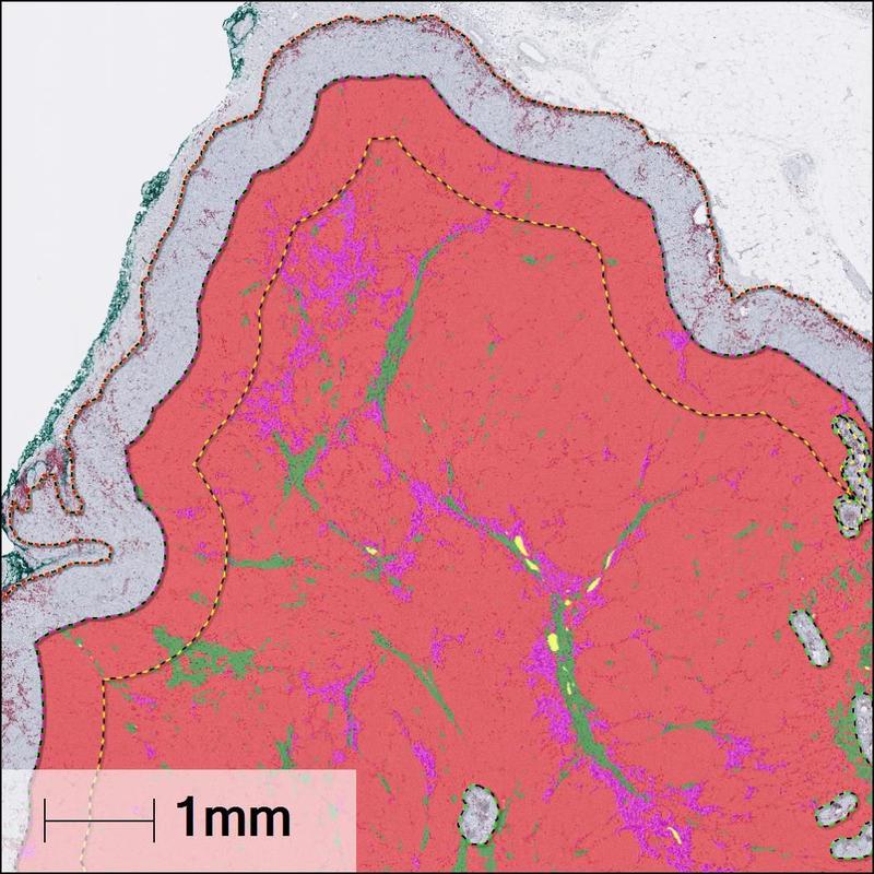 KI-basierte Segmentierung von Melanommetastasen in einem Tumor.