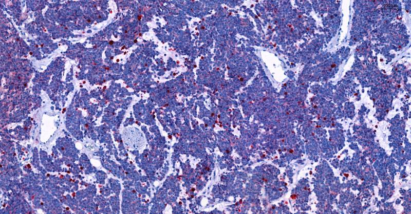 Schnitt durch das Gewebe eines Neuroblastoms, das das Krebsgen MYCN sowie das Passagier-Gen DDX1 vervielfältigt hat. Durch die Behandlung mit Rapamycin sind einige Tumorzellen abgestorben (rot). Blau: Zellkerne. 