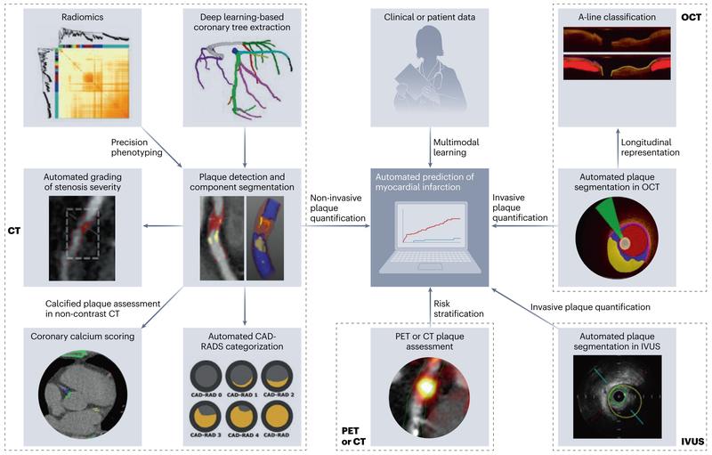 KI-gestützte Anwendungen zur Plaque-Diagnose und Prognose in der koronaren Bildgebung