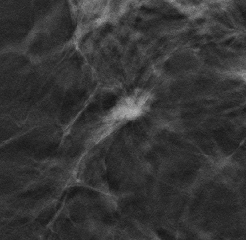 Digitale Brust-Tomosynthese der linken Brust mit Darstellung eines spikulierten Herdes erhöhter Dichte. Histologie: invasiv lobuläres Mammakarzinom Grad 2