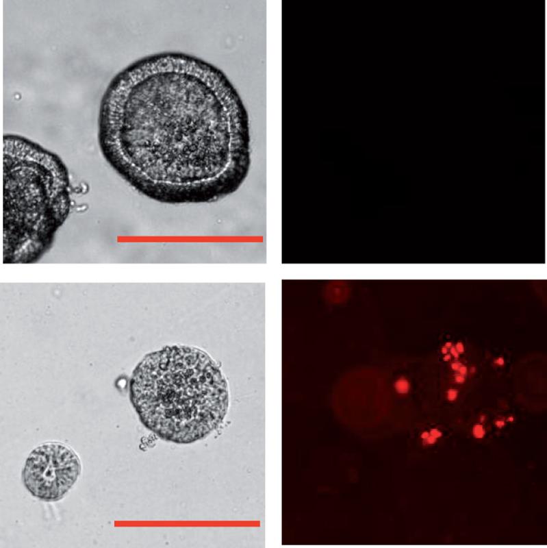 Tumoren aus Zellen von Patientinnen mit Eierstockkrebs, sogenannte Organoide (lichtmikroskopische Aufnahmen links), beginnen nach Behandlung mit p53-mRNA (untere Bilder) zu schrumpfen und abzusterben, was an Rotfärbung sichtbar wird (rechts). Balken: 200µm