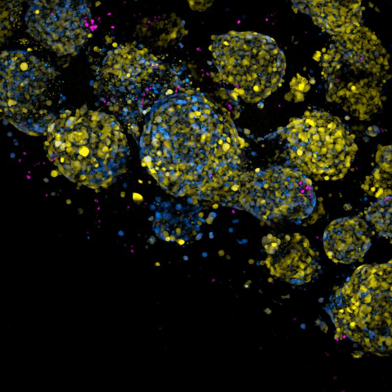 Im Labor hergestellte Immunzellen (dargestellt als magenta-farbene Punkte), die Hirntumorzellen umgeben und deren Identität durch einen dualen synthetischen DNA-gesteuerten Fluoreszenzreporter sichtbar wird (blau und gelb). 
