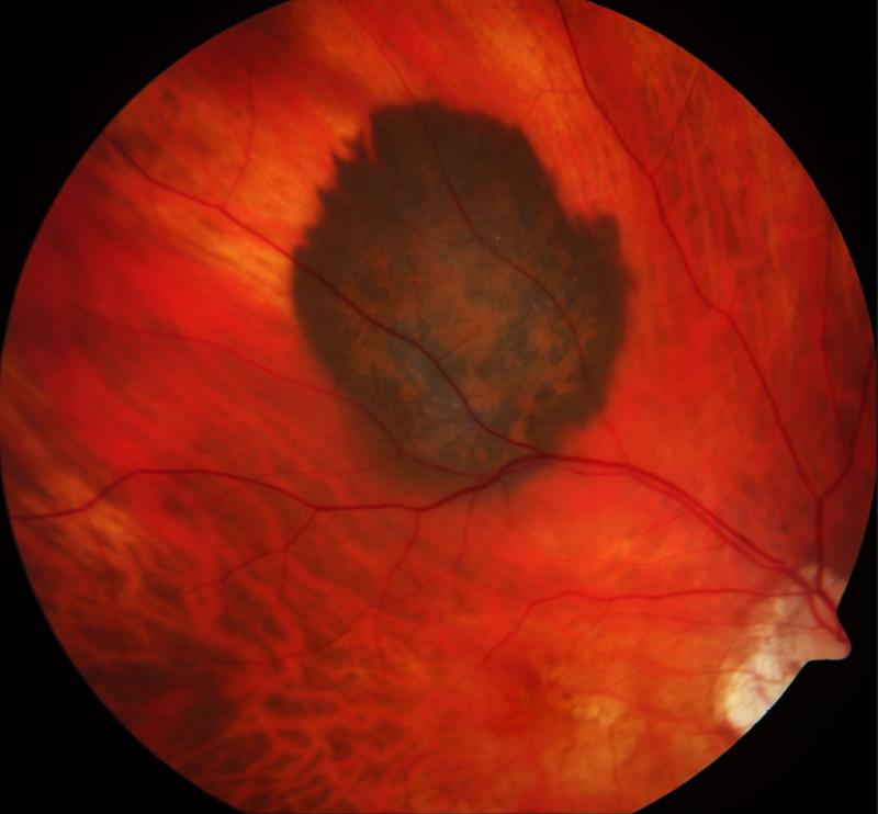 Das Aderhautmelanom zeichnet sich dunkel gegen das gesunde Gewebe des Augenhintergrundes ab.