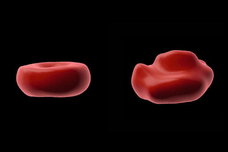 Die runde Form eines gesunden Erythrozyts (links) erinnert an einen Donut. Nach Kontakt mit Ibuprofen bilden die Blutzel-len Beulen und Zacken aus und werden zu sogenannten Stechapfelzellen. 