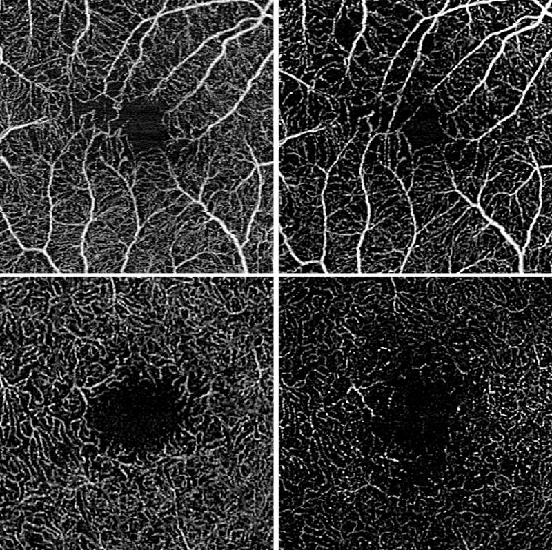 Mittels Optischer Kohärenztomographie Angiographie dargestellte Augen-Gefäßdurchblutung bei Uveitis intermedia. Die oberen Aufnahmen zeigen die oberflächliche und in die unteren die tiefe Netzhautdurchblutung.