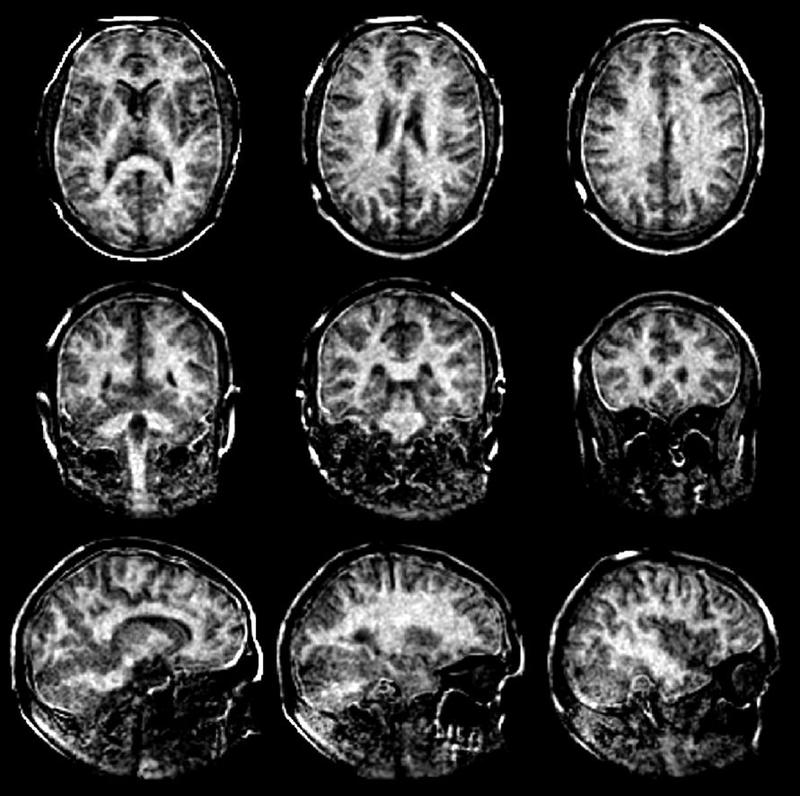 Mit besseren MRT-​Scans der Myelinscheiden im Gehirn soll Multiple Sklerose frühzeitig erkannt werden. 