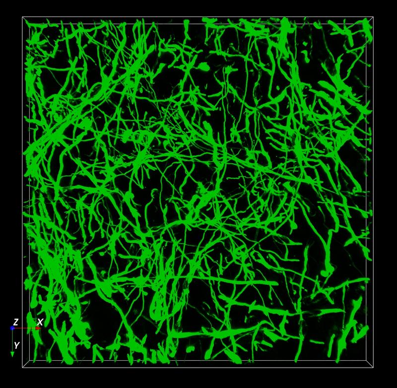 Vernetzte Tumorzellen aus Glioblastomen (grün) lassen sich anhand ihrer Genaktivität von anderen Zellen des Tumors unterscheiden.