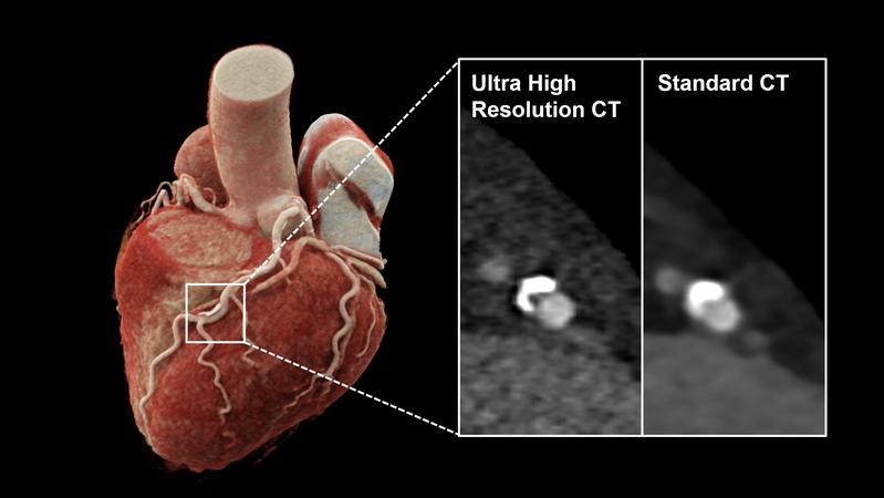 3D-Rekonstruktionen einer Computertomographie des Herzens mit Verkalkungen der linken Herzkranzarterie. Die innovative Photon-Counting-Detektor CT ermöglicht eine höhere räumli-che Auflösung (UHR, li.) im Vergleich zur herkömmlichen CT (Standard, re).