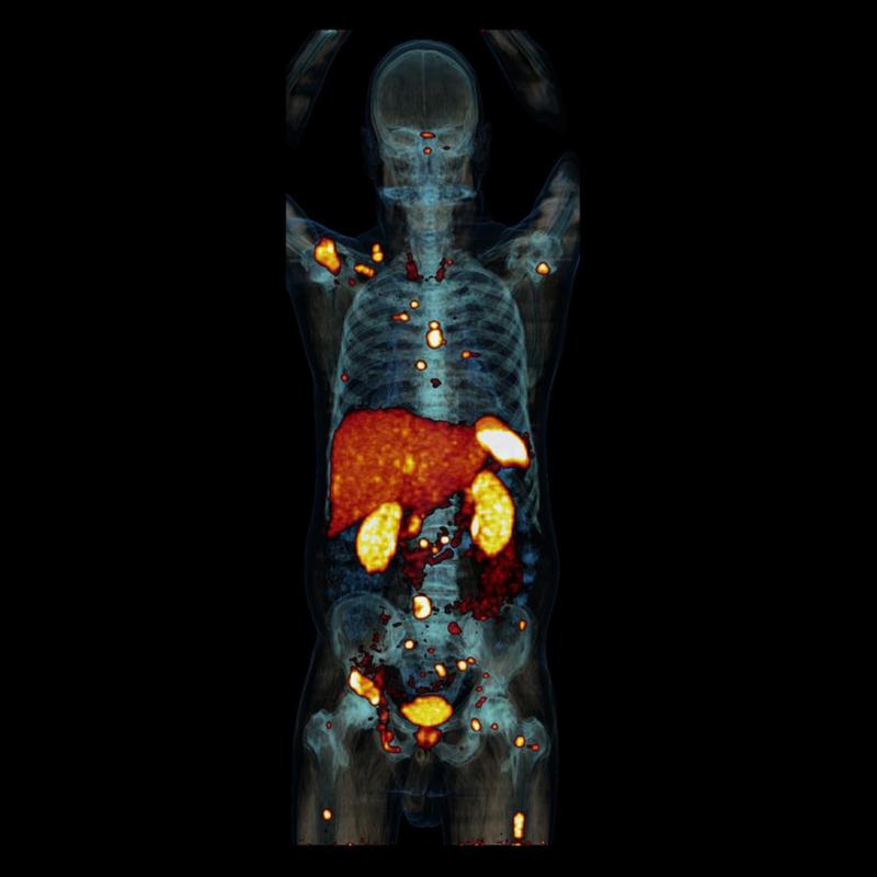 In dieser PET/CT-Aufnahme eines Patienten mit einem metastasiertem Phäochromozytom fallen neben der natürlichen Traceranreicherung in Leber, Milz, Nieren und Harnblase vor allem die zahlreichen Metastasen im Skelettsystem auf. 