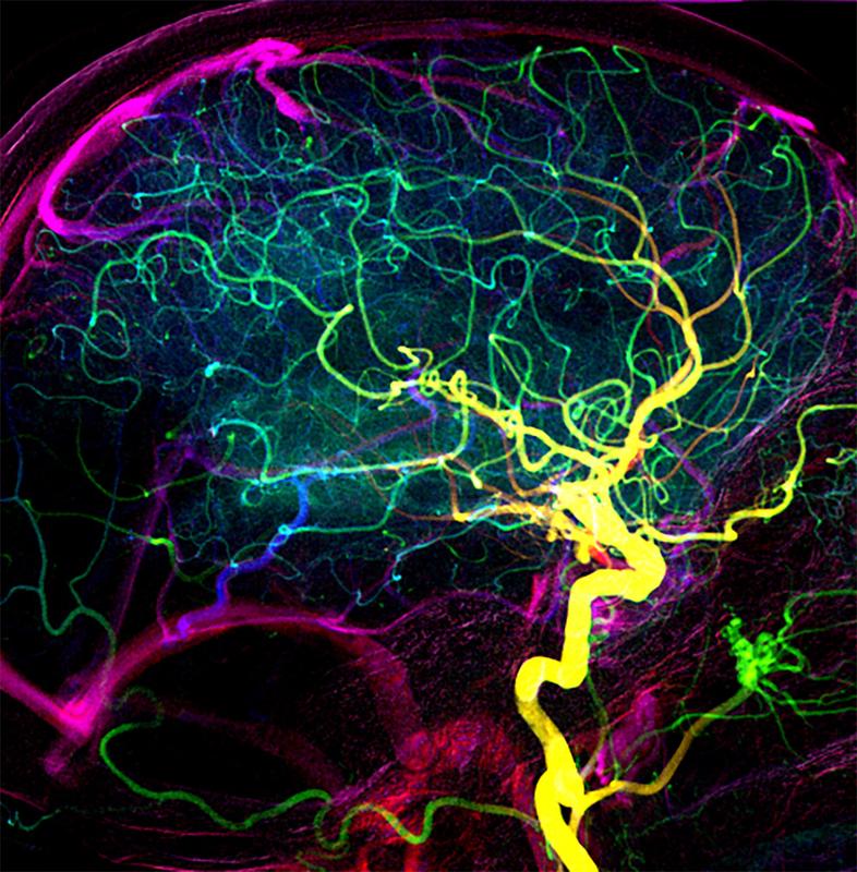 Darstellung der Blutgefässe im Gehirn eines Patienten mit früher venöser Füllung