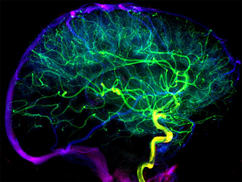 Visualization of the blood vessels in the brain of a patient without early venous filling