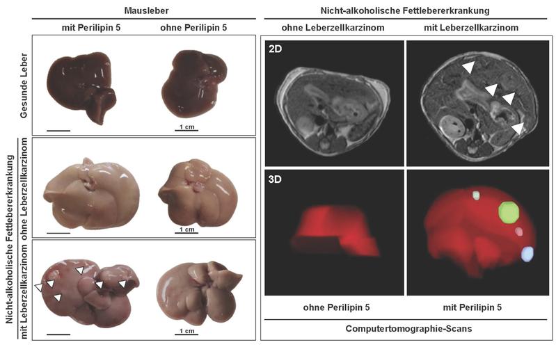 Lebern von Mäusen, nach der Entwicklung einer nicht-alkoholischen Lebererkrankung und eines hepatozellulären Karzinoms. Die Lebertumore sind sowohl in den makroskopischen Bildern als auch in den Computertomographie-Scans durch Pfeile gekennzeichnet.