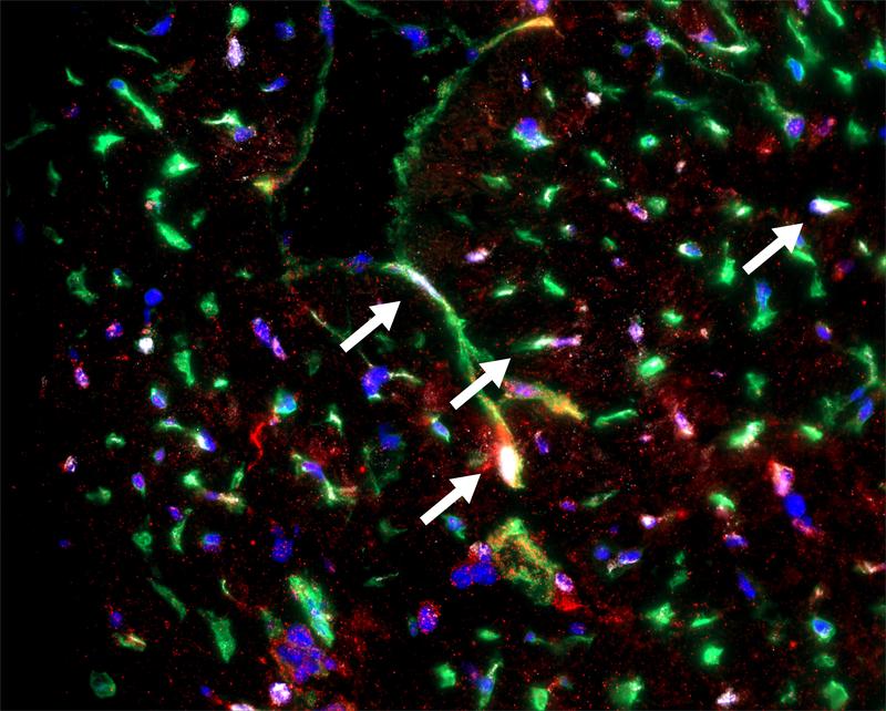 Mikroskopisches Herzpräparat, die Pfeile weisen auf fibrosefördernde Endothelzellen hin.