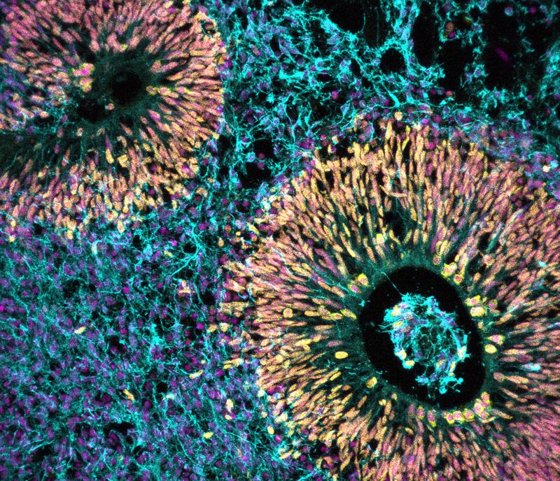 Organoid des menschlichen Gehirns, das die verschiedenen Zelltypen farblich darstellt: Zellkerne (pink), Vorläuferzellen (gelb), neu gebildete Neuronen (blau).