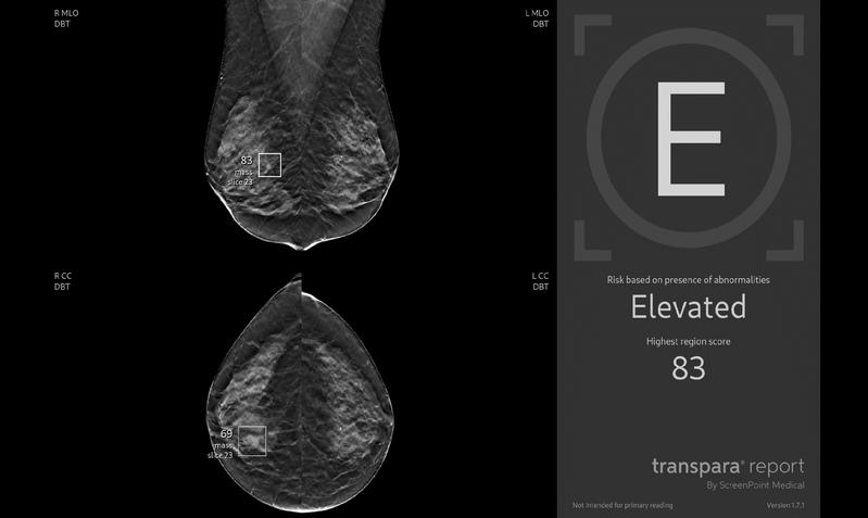 Die KI-basierte Software wertet die Bildaufnahme der Brust automatisch aus und ordnet sie einer von drei Risikokategorien zu.
