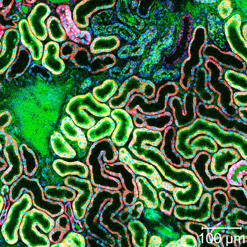 Gallensäure zerstört die Epithelzellen der Niere. Die Hemmung des dafür verantwortlichen Transportproteins soll die Nierenschädigung verhindern.