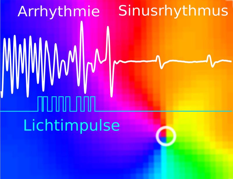 Eine ventrikuläre Herzrhythmusstörung kann durch eine Abfolge von Lichtimpulsen (blaue Linie) in einen normalen Sinusrhythmus (weiße Linie) umgewandelt werden, wie Versuche in optogenetischen Mausherzen zeigten.