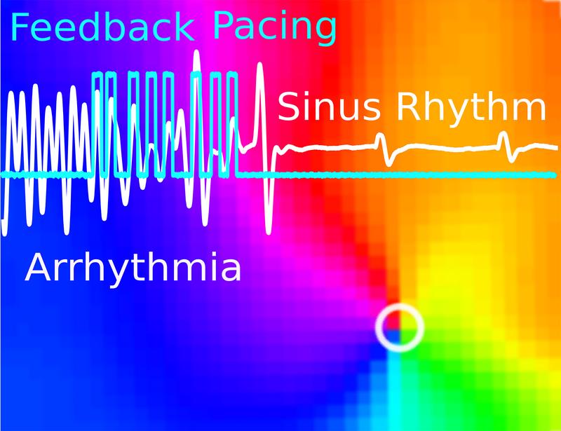 A cardiac ventricular arrhythmia can be converted to a normal sinus rhythm (white line) by using a sequence of light pulses (blue line) in an optogenetic mouse heart.