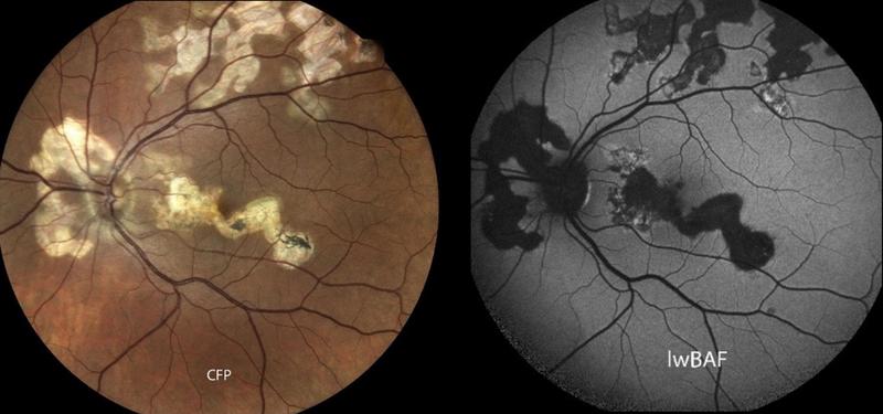 Seltene serpiginösen Chorioretinopathie: In der Augenhintergrund-Fotografie (links) zeigen sich Narbenareale in einem hellen Gelbton. Aktive entzündliche Läsionen zeigen sich in der Fundusautofluoreszenz (rechts) meist als helle Bereiche.