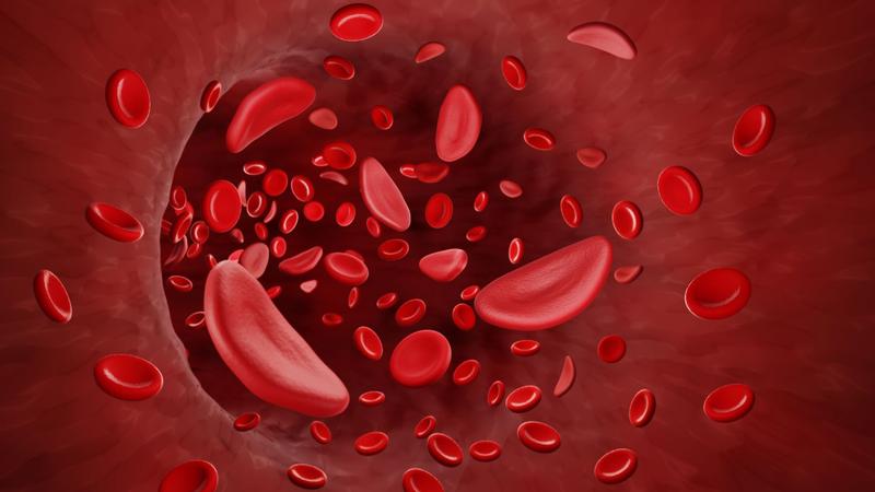 Die sonst sehr flexiblen roten Blutkörperchen werden bei Menschen mit Sichelzellkrankheit steif und nehmen bizarre Formen an, die an eine Sichel erinnern, was der Erkrankung ihren Namen verlieh. 
