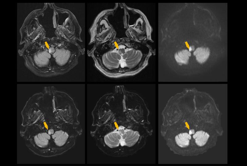 MRT-Aufnahmen des Gehirns einer Patientin mit einem akuten ischämischen Schlaganfall im Hirnstamm (gelbe Pfeile) mit der konventionellen (oben) im Vergleich zur KI-gestützten (unten) Methode und mit unterschiedlichen Aufnahmeverfahren (MRT-Sequenzen).