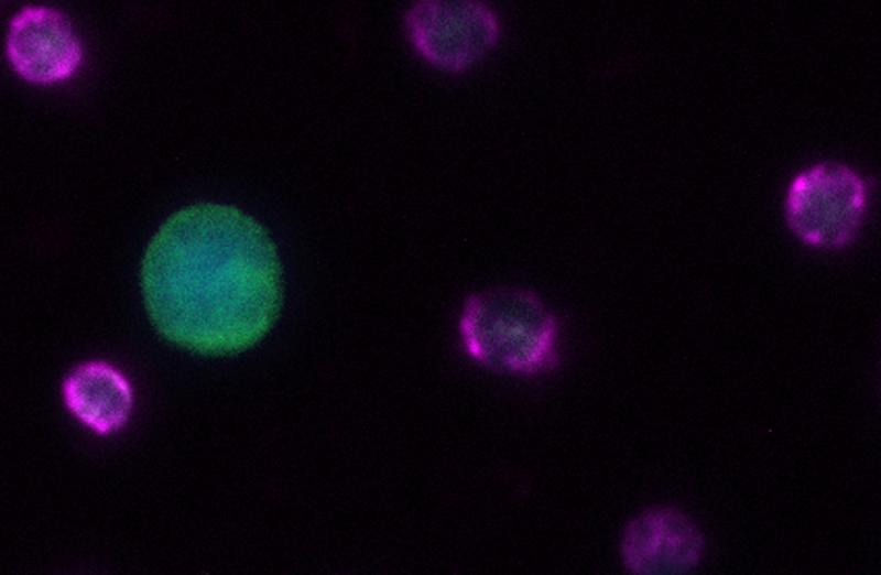 Zirkulierende Tumorzelle (CTC) aus Diagnostischer Leukapherese. Leukozytenmarker (CD45) in violett, Panzytokeratin in grün als Marker für CTCs, Kernfärbung in blau (DAPI).